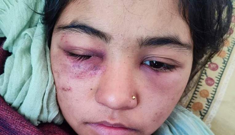 खोटाङमा सौतेनी आमाको कुटाइबाट बालिका गम्भीर घाइते, उपचारका लागि काठमाडौं लगियो